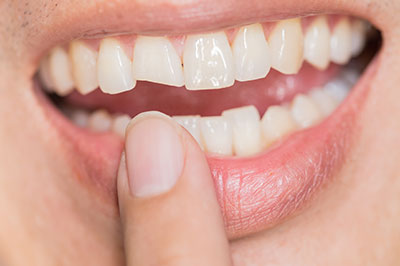 A close-up of a person s smiling mouth with crooked teeth, holding their finger in front of the teeth.