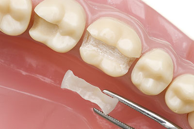 The image shows a close-up of a dental implant being placed into a prepared tooth socket.